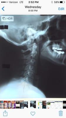 My painful neck