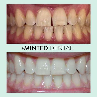 This patient hated his gap and we were able to close it successfully within 6 months!