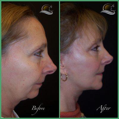 Facelift and chin implant