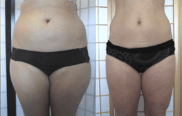 Before and After South Bay Body Sculpting!