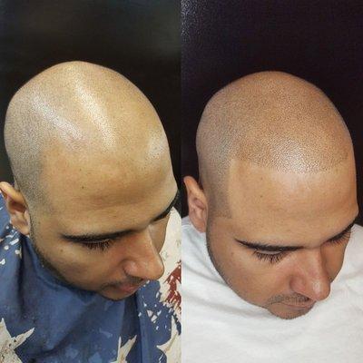 Scalp Micropigmentation expert