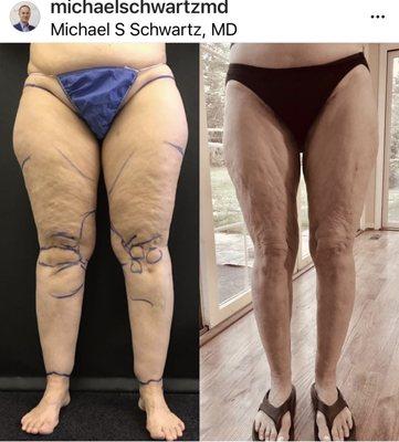 Pasadena Plastic Surgery: Michael Schwartz, MD