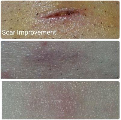 Scar Improvement