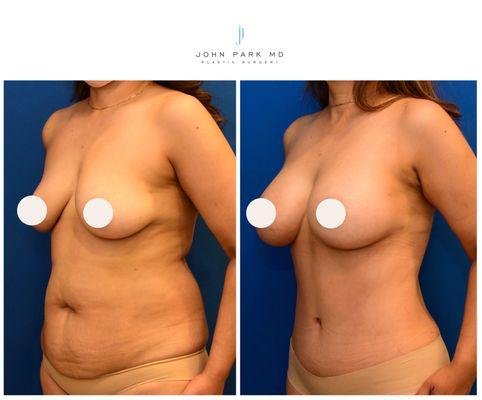 Abdominoplasty, Breast Augmentation, Liposuction Axilla/Flanks