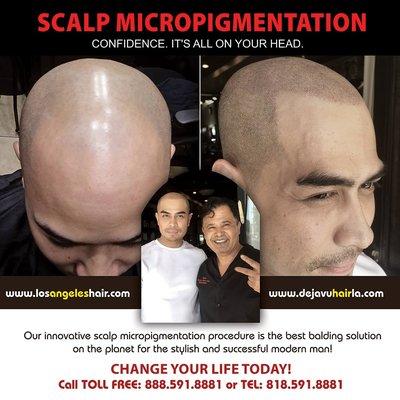 Scalp Micropigmentation