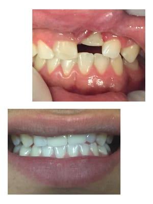 Before and After photos of a patient with tooth trauma