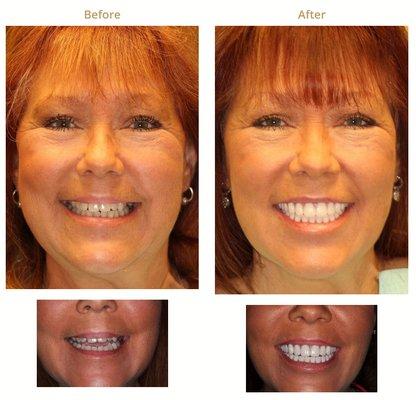 All-on-4® Implant Dentures