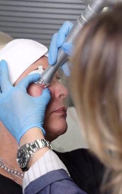 CO2 laser treatment for under eye wrinkles