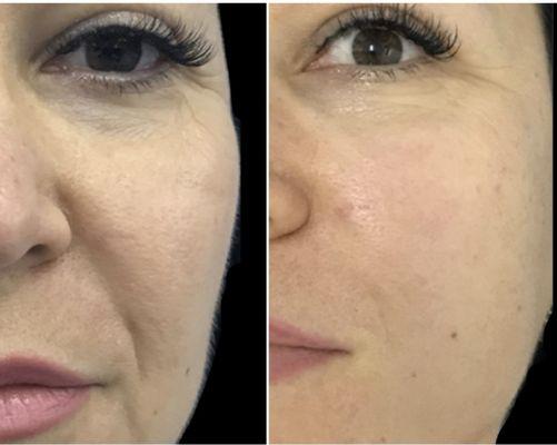 After 1 treatment - Tighten skin  -  Improved skin-tone - Less  visual fine lines