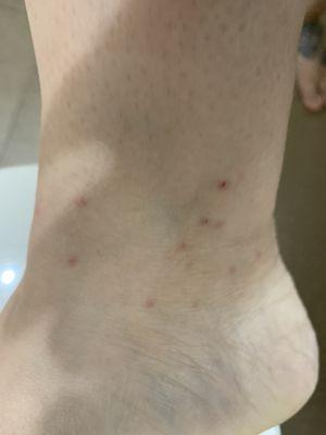 Bed bug bites