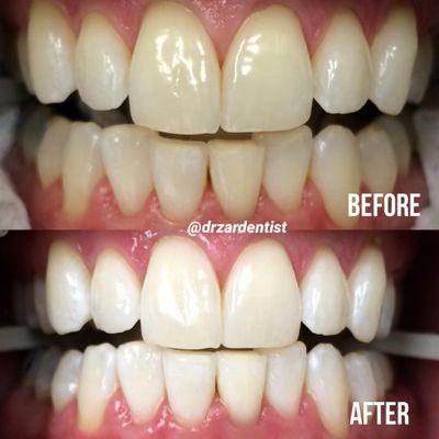 Bleach transformation for whiter teeth and a more confident smile!