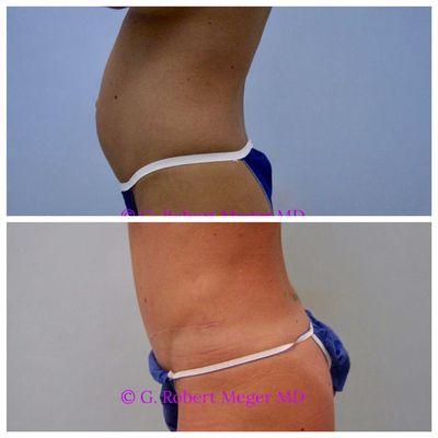 Abdominoplasty with liposuction of the flanks.