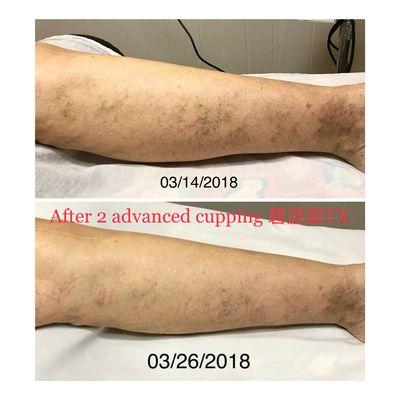 Spider veins improved after 2 advanced cupping-碧波庭treatments