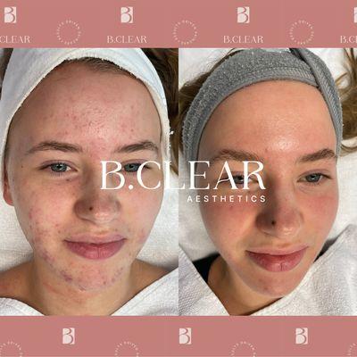 Clear Skin is Possible! Before and After results from our Acne Treatment program