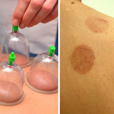 Cupping Therapy...assists with aches and pains.