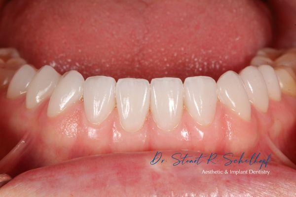 Lower veneers don't get enough attention! So please with how naturally-gorgeous this outcome turned out