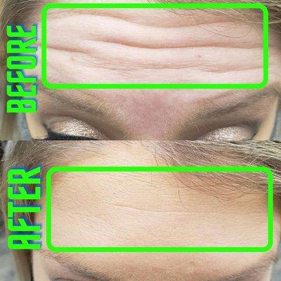 BOTOX can smooth out forehead wrinkles!