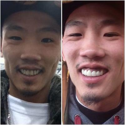 Amazing dental transformation done on my husband by Dr. Joseph Lee. His teeth look perfect and he looks like a different person!