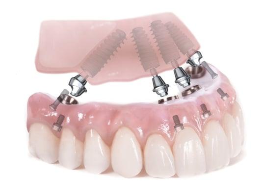 Dental implants