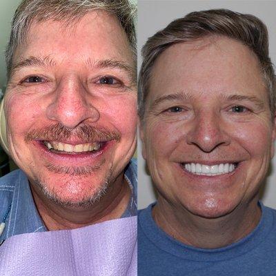 Full mouth reconstruction utilizing all ceramic crowns!