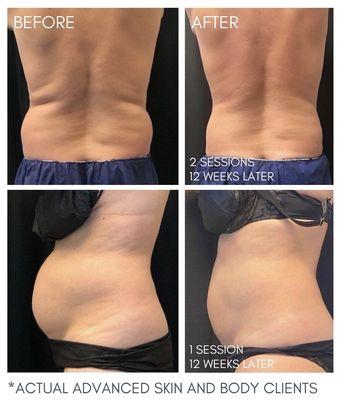 CoolSculpting Results, 12 Weeks Later