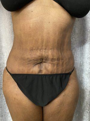 Post op care. Client came in for first massage after lipo. She waited 3 weeks! We treated fibrosis!!