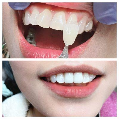 Some new crowns across the front  teeth. We can help you get the smile you've always wanted!