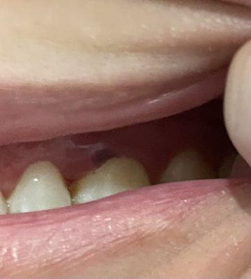 Swollen gum from aggressive cleaning.