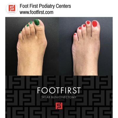 The Sklar Bunionectomy® and Toe Straightening