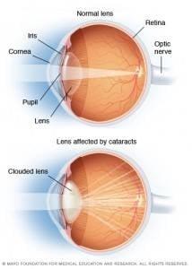 Cataract surgery