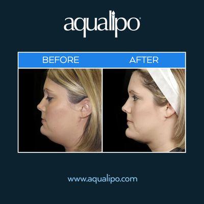 Aqualipo® Orlando provides chin & jawline liposuction for patients looking to achieve a more sculpted and defined jawline.