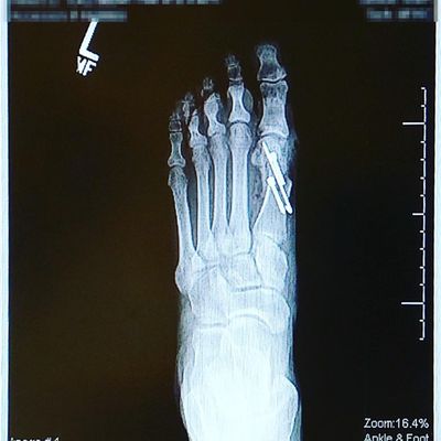 Left foot post operation