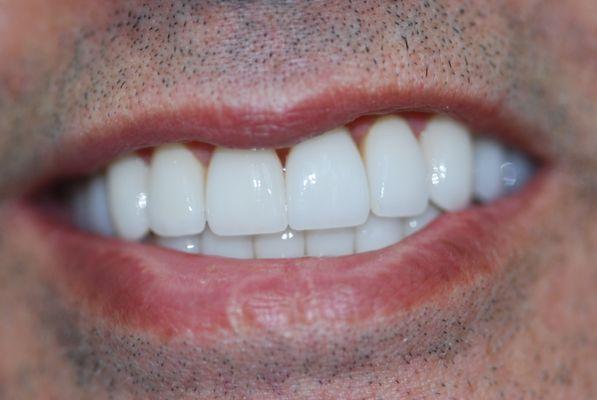 After Upper and Lower Veneers