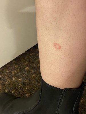 Ringworm from Hot Yoga Louisville