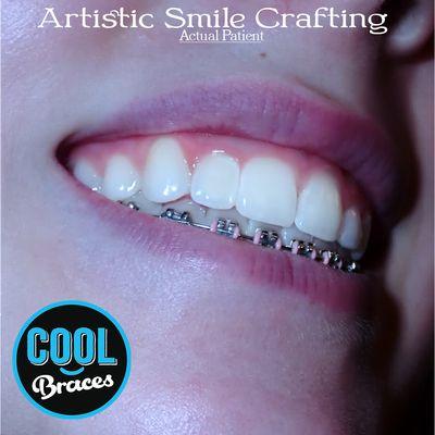 Artistic smiles every tooth from Cool Braces in Berwyn and Oak Lawn. great smiles with braces or Invisalign. Same day braces free consult