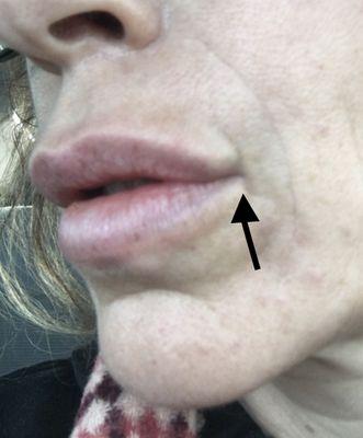 Weird filler crease above lip on one side.