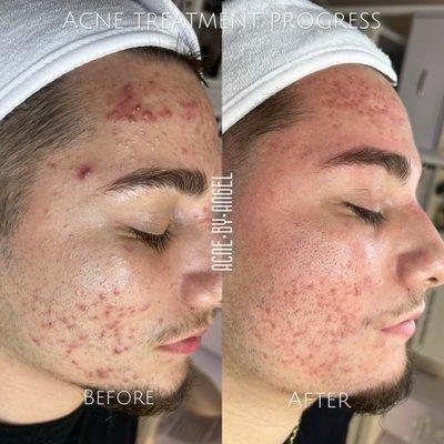 Acne  program 90% success rate. We are Face Reality Acne certified experts.