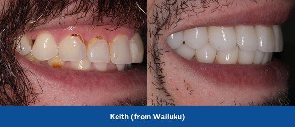 Full mouth restorative treatment with crowns & veneers re-established tooth size, function, & cosmetically enhanced his smile.