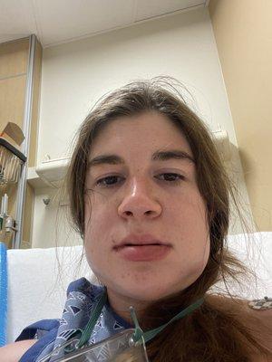 ~9 hours post op. This was my "wtf have I done to my face" moment lol