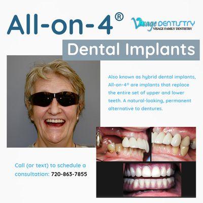 All-on-4 dental implants in Highlands Ranch at Visage Dentistry