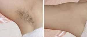 Hair Removal (Laser Procedure 3 to 4 sessions / Under-Arm Area)