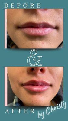 Lip enhancement with Restylane