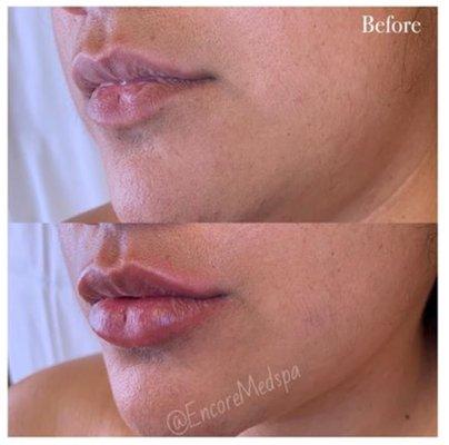 Mini Plump: .5ml of Juvéderm Ultra XC to add volume, hydration and definition to this patient's lips.