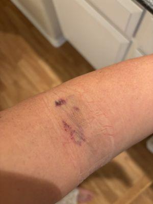 Punctured veins (she blew a vein!) basically went in too much and came out the other side   Has been hurting all day and so sore