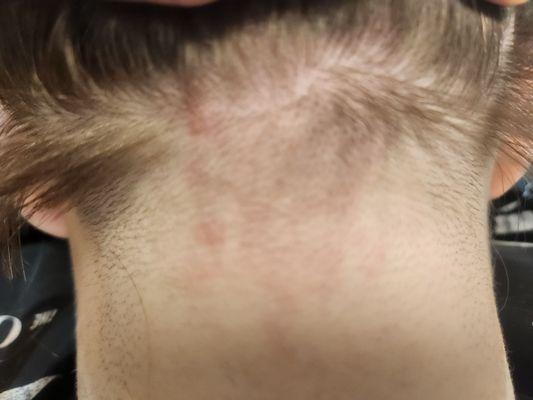 Blisters on my daughter's neck Amy French left as a result of hair color.