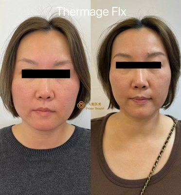 2 weeks after Thermage FLX.  Significant improvement. Less puffiness. Slimmer face.