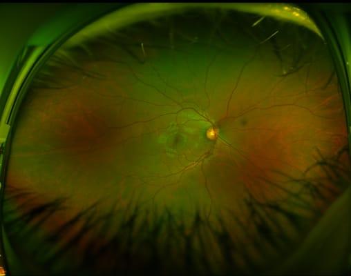 Digital Retinal Imaging. (Captures greater than 80% of retina in one image, while traditional practicing methods reveal 10-15% of retina)