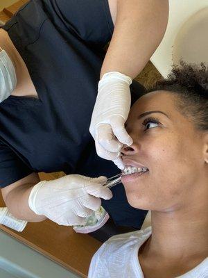 This photo is of me getting my braces tightened however you can see some of the scarring (dark spots) along my jawline.