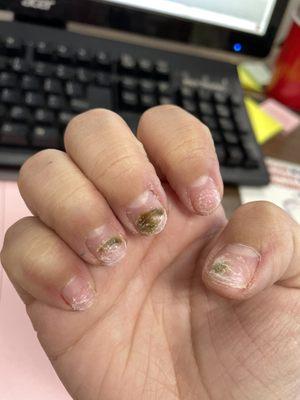 Fungus or "water damage" nails?