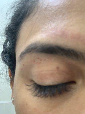 Cuts under brow from threading and bruising over the brow.